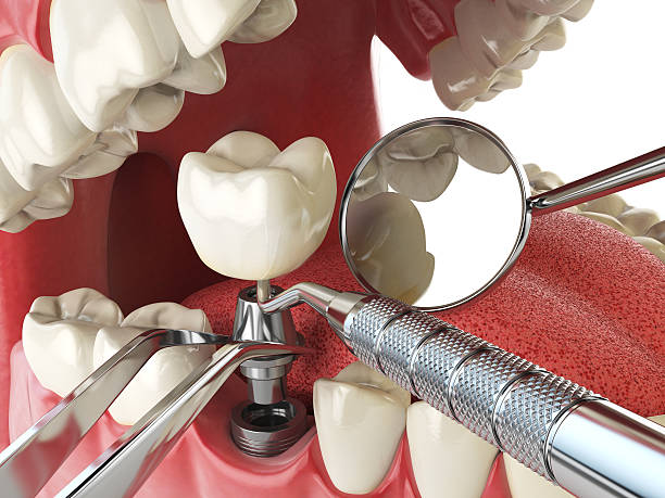 Best Emergency Wisdom Tooth Extraction in Landing, NJ